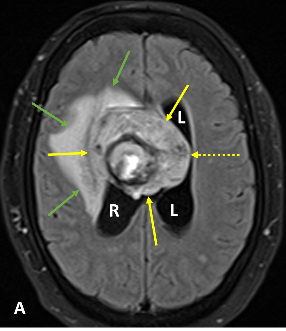 Intraventricular Hemorrhage (IVH) - Diagnosis - MRI Online