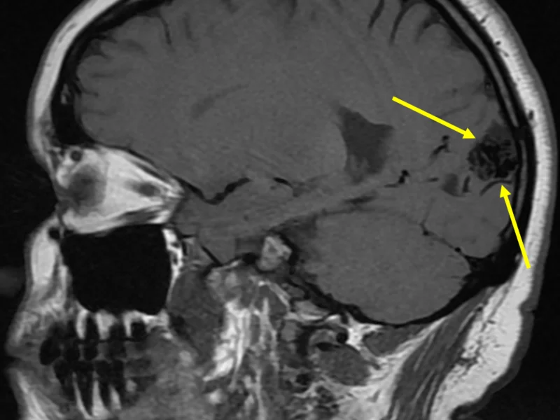 AVM in a 23-year-old woman with optic nerve swelling on physical examination, visual field defects, and headache for 4 days. A. Sagittal T1 MR image shows a 2.6 cm parenchymal mass (arrows) composed of multiple low signal serpiginous flow voids within the cuneus portion of the occipital lobe, just below the parieto-occipital sulcus and to the right of midline. There is no surrounding edema or hemorrhage.