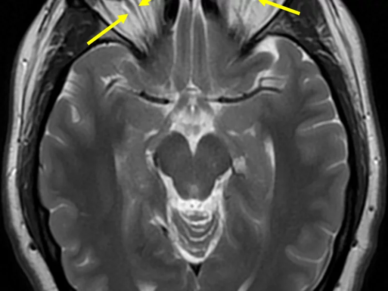 E. Axial T2 PROPELLER image at a level inferior to (C) shows excess high signal cerebrospinal fluid (arrows) surrounding the low signal optic nerves. This represents nerve sheath dilatation and is consistent with increased intracranial pressure. There is also optic disc cupping indicative of papilledema.