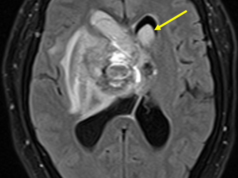 B. Axial FLAIR image inferior to (A) shows extension of blood into the frontal horn of the left lateral ventricle (arrow).