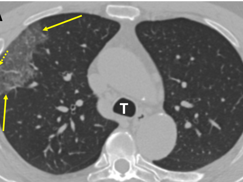COVID-19 pneumonia in a Chinese man with a positive RT-PCR test (Images courtesy of Michael K. Atalay, MD, PhD). A. CT scan at the level of the trachea (T) shows peripheral ground glass opacity (GGO) in the right upper lobe (solid arrows). There are also linear dense areas of septal thickening (dashed arrow).