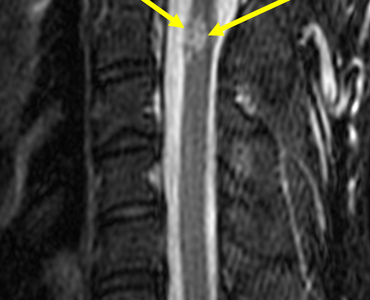 B. Sagittal STIR image shows the mass (arrows) to be predominantly hyperintense with punctate areas of low signal, creating a “mulberry” appearance.