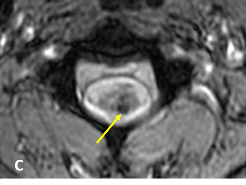 C. Axial GRE image shows prominent areas of low signal (arrow) within the mass, consistent with hemosiderin related to hemorrhage.