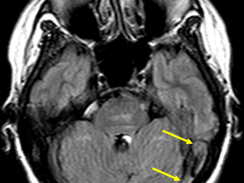 B. Axial FLAIR image at the same level as (A) shows hyperintense signal within the left transverse and sigmoid sinuses (arrows).
