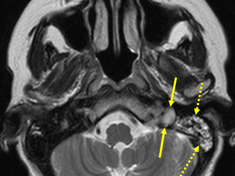 C. Axial T2 RESTORE image at a level inferior to (A) shows the left proximal internal jugular vein (IJV) to be of abnormal high signal (solid arrows), consistent with slow flow or thrombosis. This could be differentiated with MR venography. Note high signal within the left mastoid sinus (dashed arrows), which may represent edema or congestion altering the venous flow and causing left IJV thrombosis.