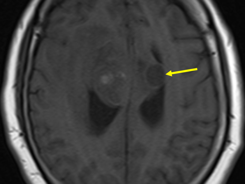 D. Axial T1 image shows a low signal, circumscribed cystic component (arrow) within the mass, suggesting necrosis.