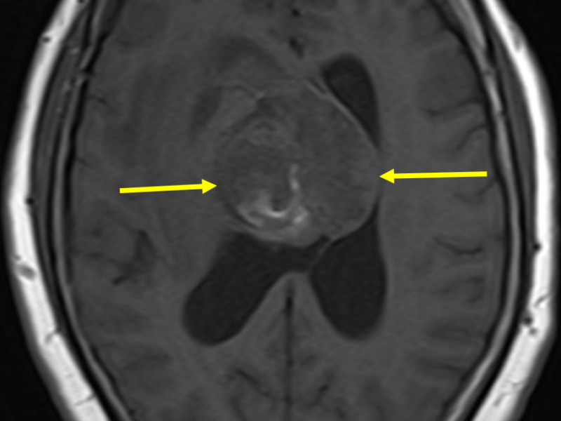 E. Axial T1 image at the same level as (A, C) shows the mass (arrows) to be predominantly low signal.