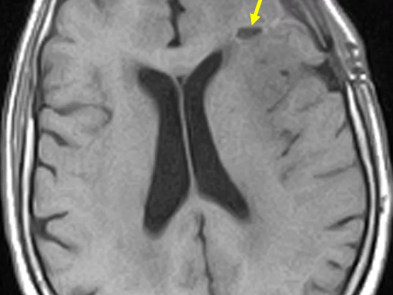 Glioblastoma in a 74-year-old man with dizziness. A. Axial T1 SE MR image shows an ill-defined left frontal lobe low signal mass (arrow) with associated minimal mass effect on the left lateral ventricle and marked surrounding low-signal edema.