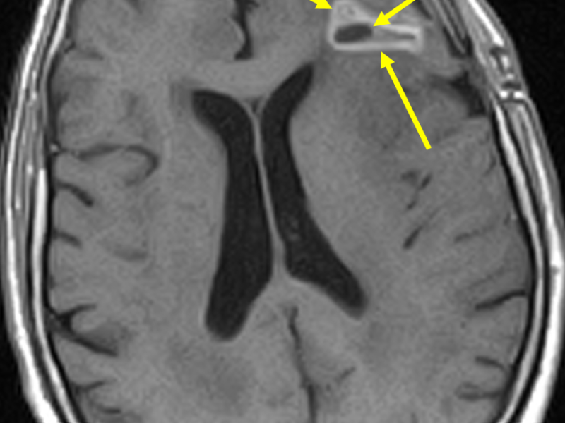 B. Axial T1 SE image at the same level as (A) post contrast shows a central low-signal necrotic focus ( short arrow) and surrounding thick, irregular high-signal enhancement (long arrows). There is no meningeal enhancement or evidence of leptomeningeal seeding.