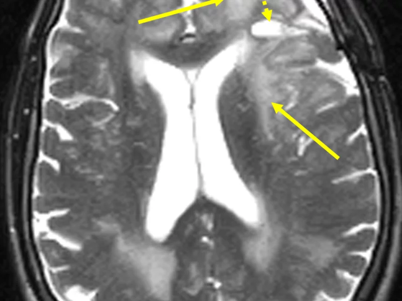 C. Axial T2 FSE image at the same level as (A) shows marked high-signal vasogenic edema (solid arrows). The signal characteristics of the central portion of the mass (low signal on T1 and high signal on T2) is consistent with cystic necrosis (dashed arrow).