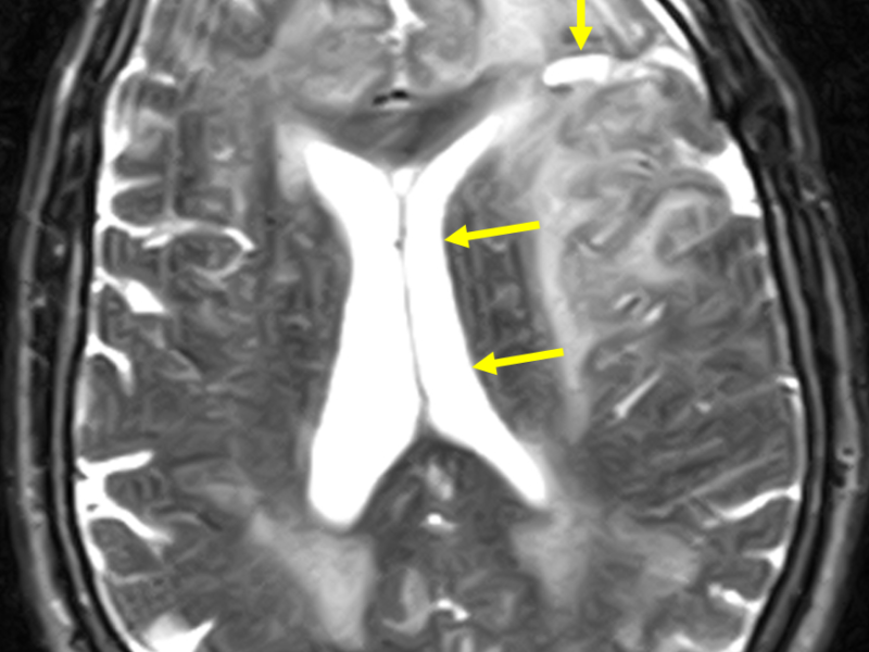 D. Axial T2 FSE image at the same level as (A) post chemotherapy and radiation treatment shows decreased size of the cystic mass (long arrow), increased high signal abnormality posteriorly, greater mass effect on the left lateral ventricle (short arrows), and greater sulcal effacement. Extensive white matter changes involving the periventricular, left frontoparietal, and right frontal areas may represent a combination of post treatment effects and infiltrating neoplasm.