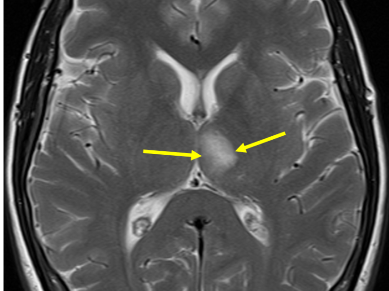 B. Axial T2 image at the same level as (A) shows increased signal within the left thalamus (arrows).