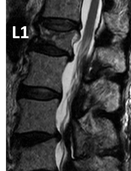 B. Sagittal T2 image shows hypointense marrow infiltration of the visualized thoracic and lumbar spine and compression deformities of L1 and L4.