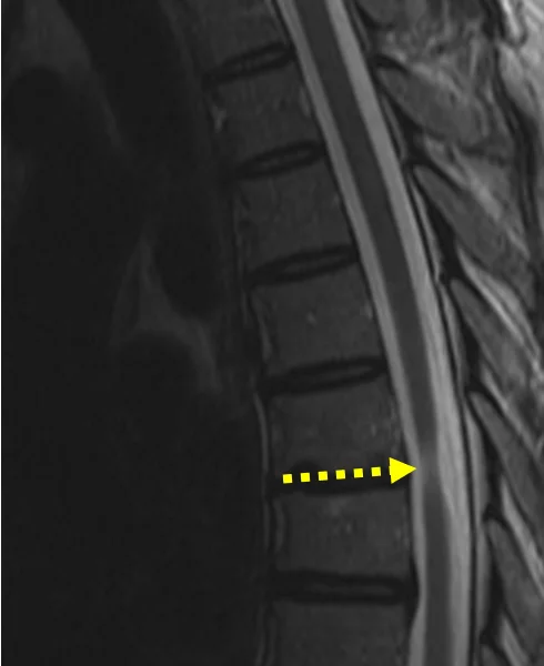 Multiple sclerosis in a 44-year-old man with exacerbation of symptoms for six months. A. Sagittal T2-weighted MR image of the thoracic spine shows a subtle focus of high signal within the spinal cord at T2 (solid arrow). There is also focal high signal at T7-8 (dashed arrow), associated with cord atrophy, consistent with chronic disease.