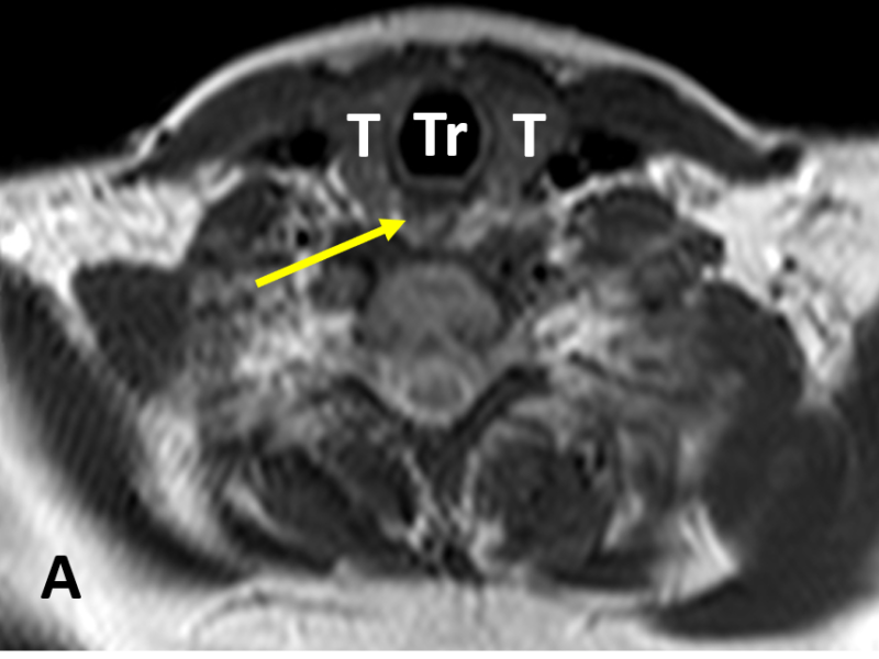 Parathyroid adenoma in a 20-year-old woman. A. Axial T2 MR image shows normal thyroid glands (T) lateral to the trachea (Tr) and anterior to the esophagus (arrow).