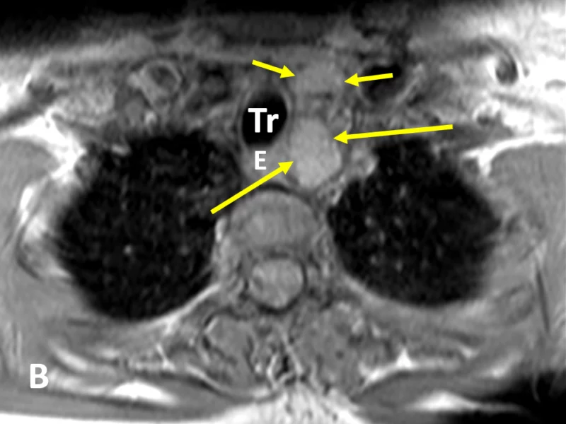 B. Axial T1 SE image shows a 2.8 cm circumscribed, isointense to thyroid, oblong mass (long arrows), posterior to and separate from the left thyroid gland (short arrows), in the left tracheoesophageal groove. The mass causes slight rightward deviation of the trachea (Tr) and esophagus (E). The location and signal characteristics of the mass are typical of a parathyroid adenoma.