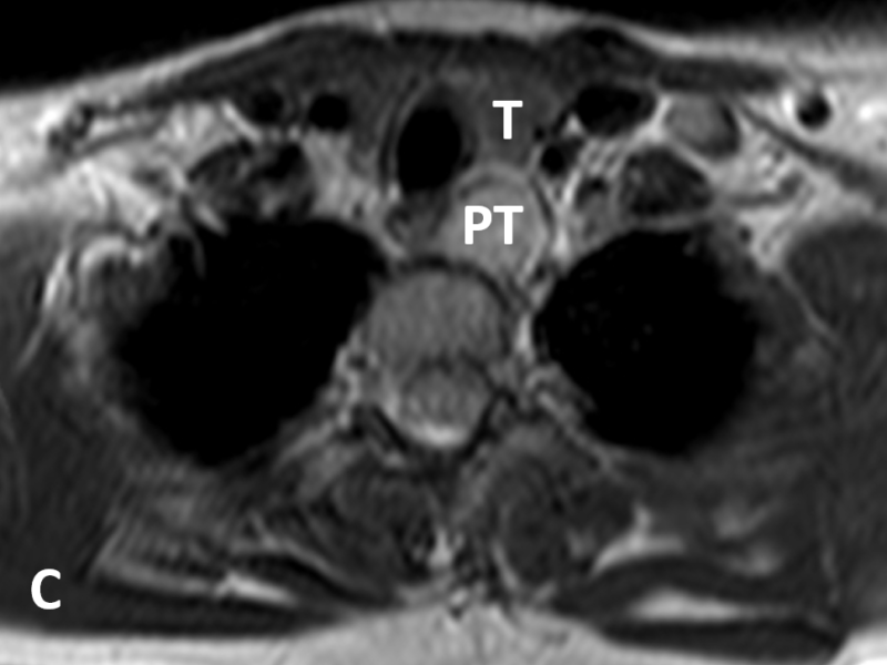 C. Axial T2 image shows the parathyroid adenoma (PT) to be hyperintense relative to the thyroid (T).