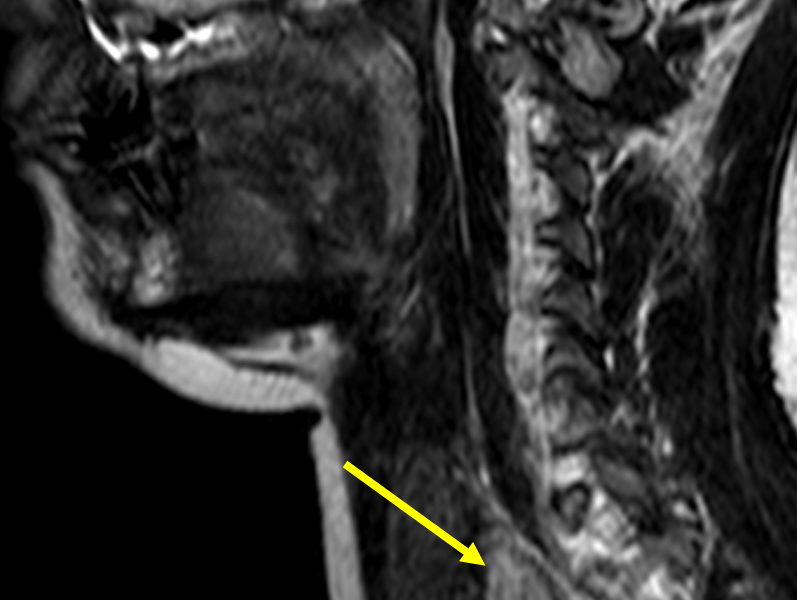 F. Sagittal T2 TSE image shows the high signal adenoma (arrows) anterior to the upper thoracic spine.