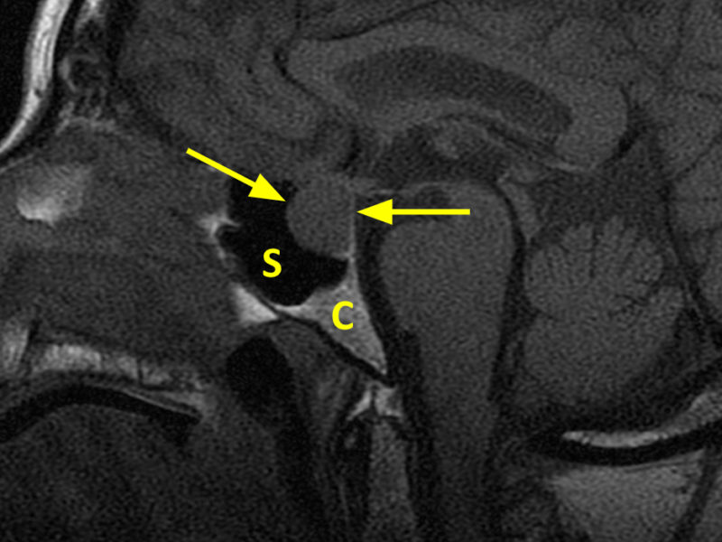 (A) Pituitary macroadenoma in a 64-year-old woman with decreased peripheral vision. A. Sagittal T1 SE 3mm slice MR image shows the sella turcica expanded by a 2 cm sellar and suprasellar mass (arrows). There is no retrosellar extension. The sphenoid sinus (S) is patent. There is no extension inferiorly to involve the clivus (C).