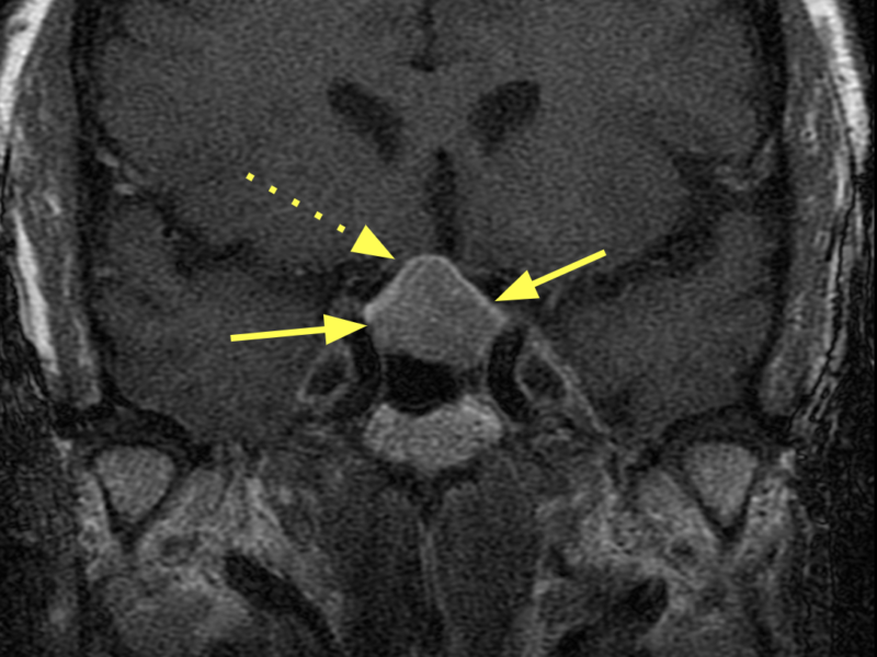 (C) Coronal T1 SE 3mm slice post-contrast shows the mass (solid arrows) to be slightly asymmetric; the superior and right lateral portion creates mass effect on the area of the optic chiasm (dashed arrow).