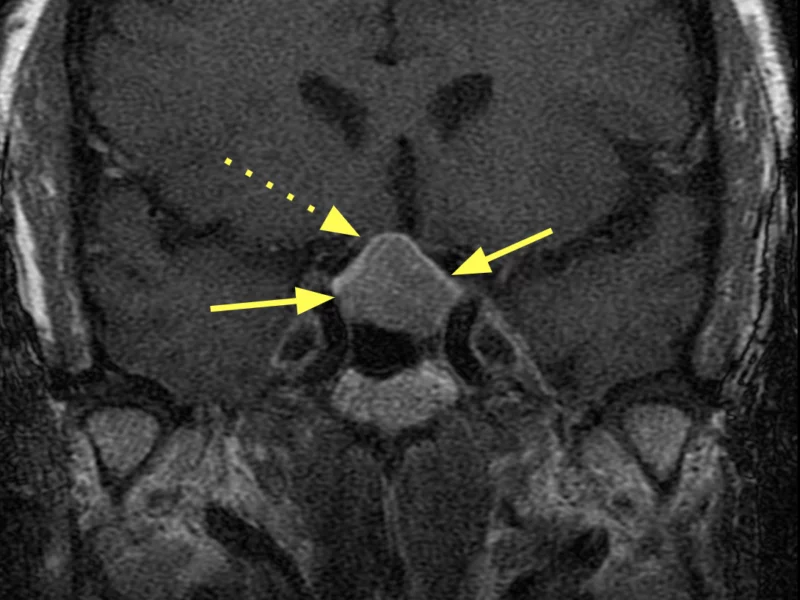 (C) Coronal T1 SE 3mm slice post-contrast shows the mass (solid arrows) to be slightly asymmetric; the superior and right lateral portion creates mass effect on the area of the optic chiasm (dashed arrow).