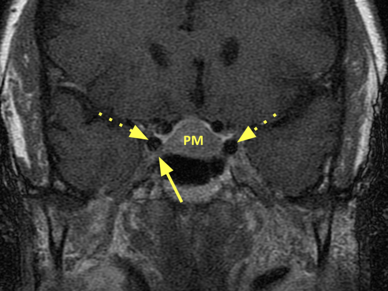 (D) Coronal T1 SE 3mm slice post-contrast, anterior to (C), shows the tumor (PM) extending into the right cavernous sinus (solid arrow); there is no effacement of the carotid arteries (dashed arrows).