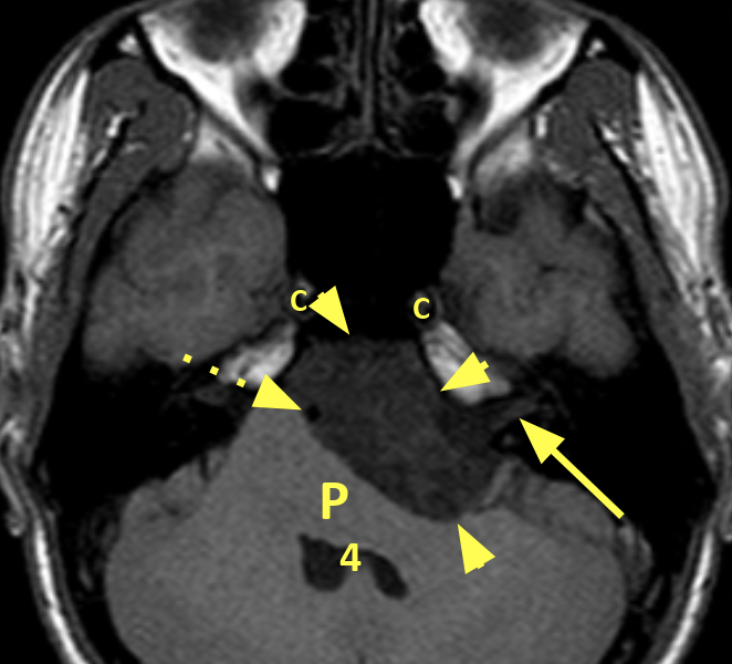 Epidermoid cyst in a 26-year-old male. A. Axial T1 image shows a 7 cm undulating low signal mass (short arrows) in the left cerebellopontine angle. The basilar artery (dashed arrow) is displaced to the right and the posterior pons (P) and 4th ventricle (4) are compressed. The left vestibulocochlear nerve is displaced posteriorly (long arrow). The internal carotid arteries are patent (C).
