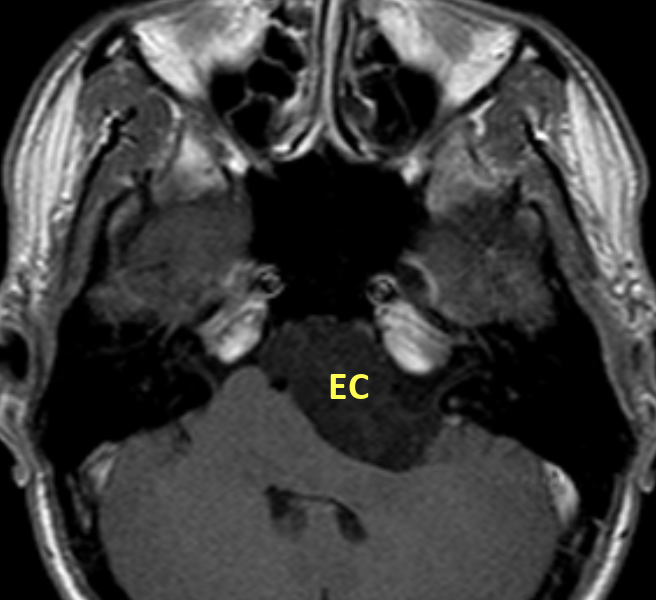 C. Axial T1 image post contrast shows no enhancement of the lesion (EC), which is typical of epidermoid cysts.