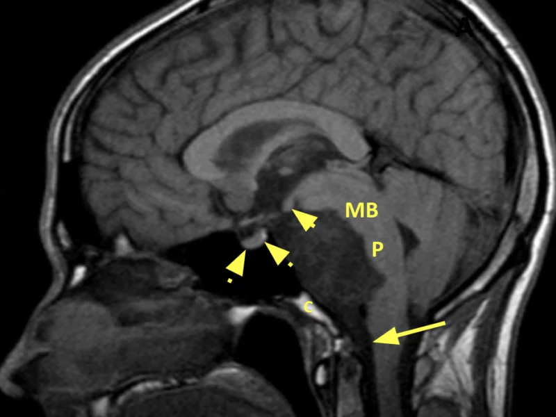 D. Sagittal T1 image shows the cyst extending along the markedly thinned clivus (C) extending from the undersurface of the mammillary bodies (short solid arrow) to the foramen magnum (long solid arrow). The lesion is posterior to a normal appearing sella (dashed arrows). The midbrain (MB) and pons (P) are compressed posteriorly.