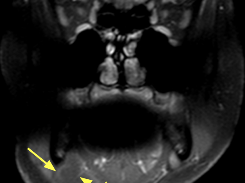 C. Coronal T1 image with contrast, anterior to (B) and posterior to (C) shows the anterior aspect of the mass (long solid arrows) to be of homogeneous low signal except for a few septations (short arrows), which are commonly seen in post-surgical recurrence. A skin marker is seen (dashed arrow).