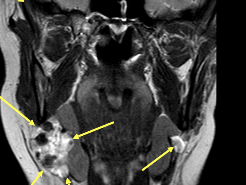 C. Coronal T2 TSE image shows heterogeneous signal within both submandibular glands (arrows), and lobular enlargement of the right gland. The normal right parotid gland is seen (dashed arrow).
