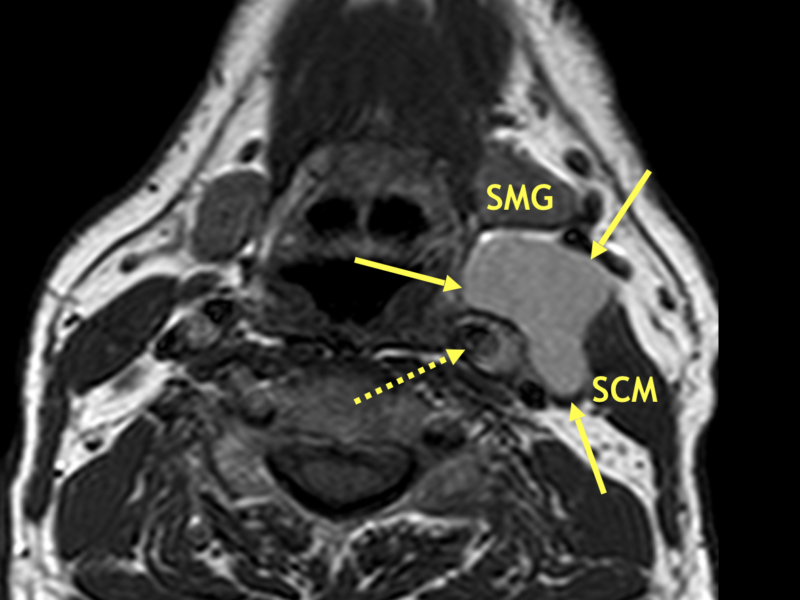 Second branchial cleft cyst (BCC) in a 60-year-old man with a painless lump in the left neck. A. Axial T1 SE MR image shows a 4 cm circumscribed, lobular thin-walled mass (solid arrows) medial to the sternocleidomastoid muscle (SCM), lateral and anterior to the carotid artery (dashed arrow), and posterior to the submandibular gland (SMG), the classic location for a second BCC. The SMG is displaced anteriorly. Increased signal intensity of the mass is due to either proteinaceous debris or prior hemorrhage.