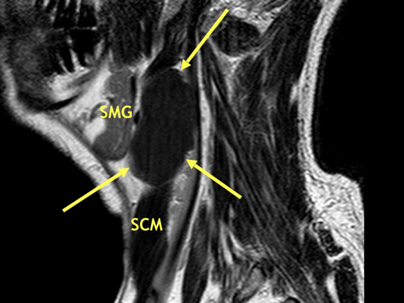 C. Sagittal T2 SE image shows the mass (arrows) to be homogeneously hypointense, consistent with accumulation of proteinaceous debris or hemorrhage. The BCC is posterior to the submandibular gland (SMG) and borders the anterior sternocleidomastoid muscle (SCM) at the mandibular angle.