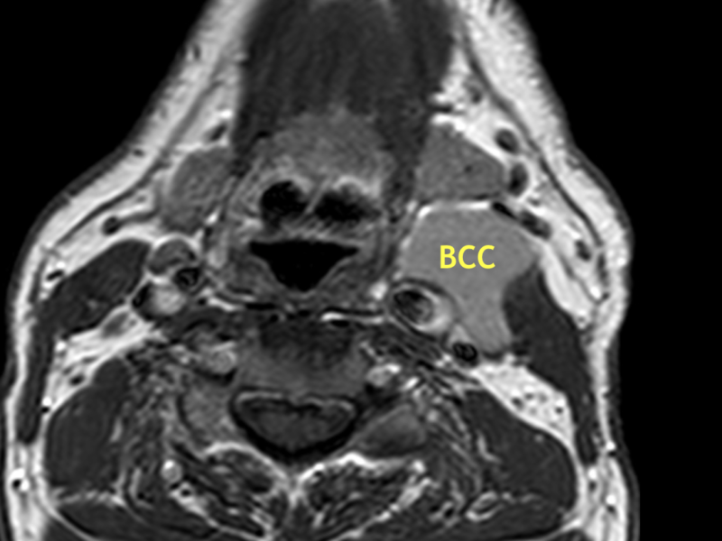 B. Axial T1 SE image post contrast shows no enhancement of the mass (BCC).
