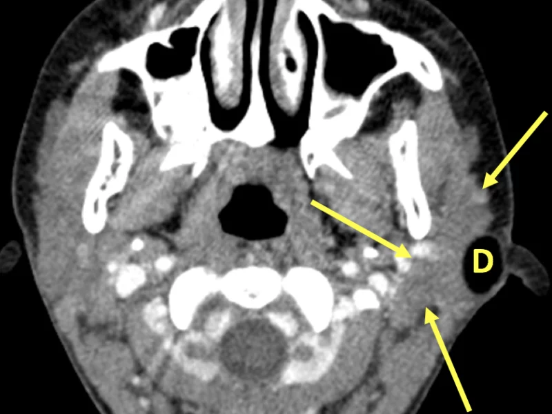 Subcutaneous dermoid cyst in an 11-year-old girl with a neck mass below the ear where fluid was drained a year prior. A. Thin section (1.5 mm) Axial CT with contrast shows a 2 cm circumscribed, ovoid mass of fat attenuation (D) superficial to and compressing the left parotid gland (arrows).