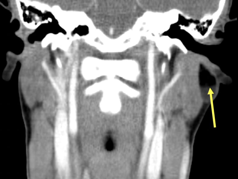 C. Coronal reformatted CT image with contrast shows a fat/fluid level (arrow) within the cyst.