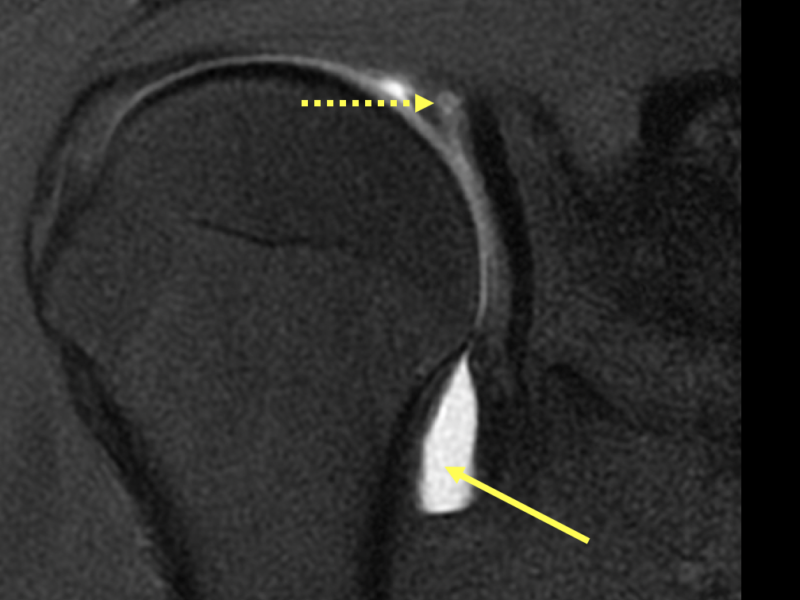 Spinoglenoid Notch Cyst associated with a labral tear in a 23-year old male football player with recent football injury and shoulder pain. A. Coronal T1 fat saturated MR image post direct arthrogram shows intra-articular contrast (long solid arrow) and a superior labral tear (dotted arrow).