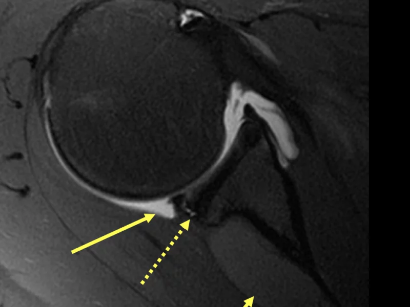 B. Axial PD fat saturated image post direct arthrogram shows intra-articular contrast (long solid arrow), posterior labral tear (dotted arrows) and large intermediate signal paralabral cyst in the spinoglenoid notch (short arrow).