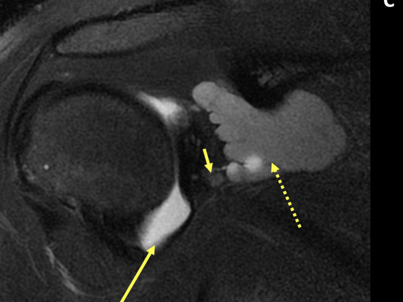 C. Coronal T2 fat saturated image post direct arthrogram shows intra-articular contrast (long solid arrow), large intermediate signal paralabral cyst in the spinoglenoid notch (dotted arrow) and a thin track of communication between the labral tear and paralabral cyst (short arrow).