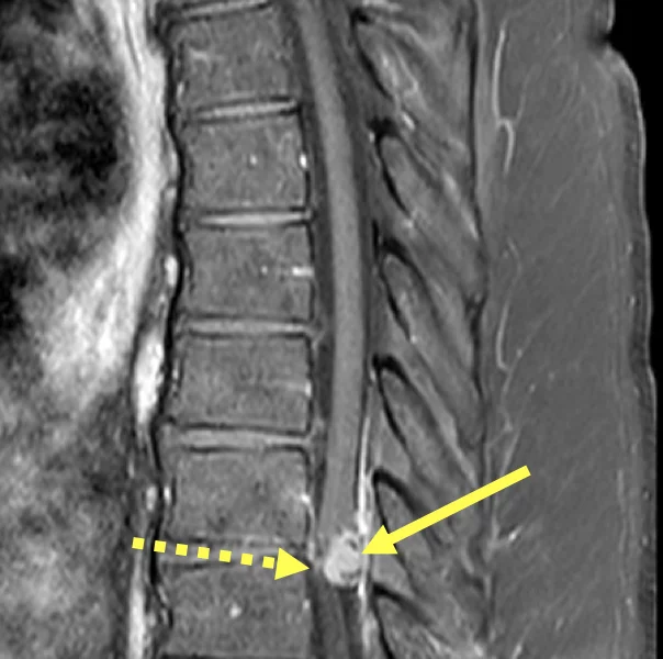 Spinal meningioma in a 66-year-old man with back and bilateral leg pain, and prior lumbar spine surgery. A. Sagittal T1 MR image post contrast shows a 13 mm avidly enhancing posterior intradural extramedullary mass (solid arrow) at the level of the T9-T10 disc space. The spinal cord is displaced and compressed anteriorly (dashed arrow).