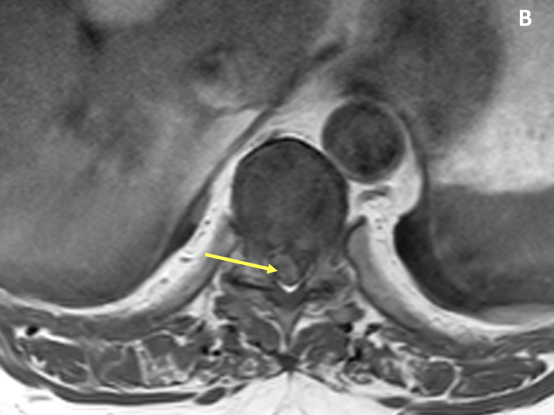 B. Axial T1 image post contrast shows a laterally located, circumscribed, enhancing mass (arrow) displacing the spinal cord to the left.