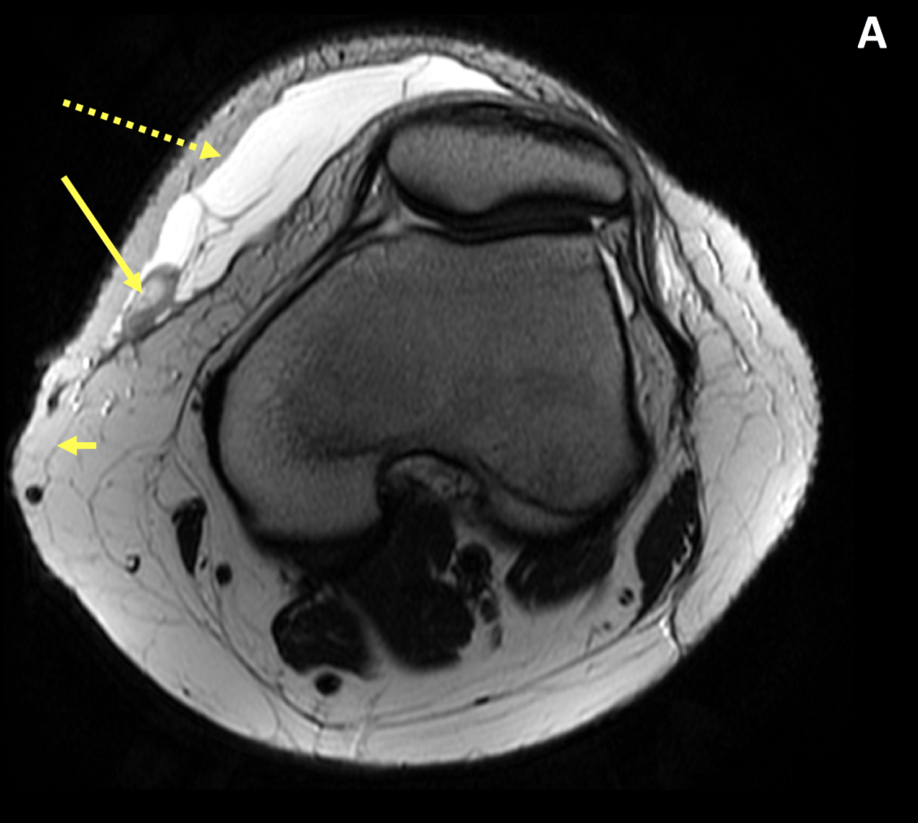 Morel Lavallee Lesion Mll Diagnosis Mri Online