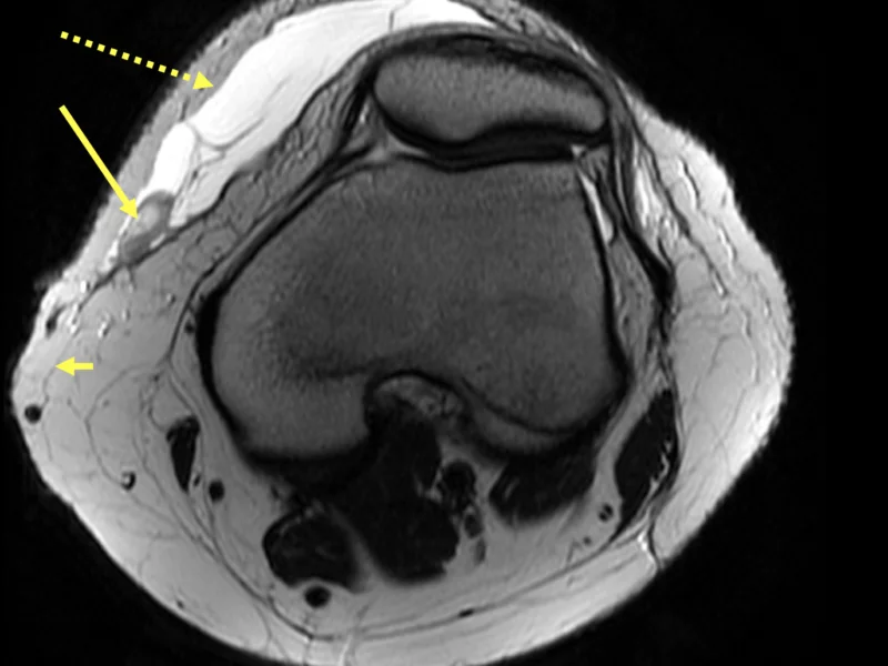 Morel-Lavalle lesion in a 14 year old with recent trauma to the left knee with pain, bruising and swelling. A. Axial T2 of the left knee shows a large T2 hyperintense deep subcutaneous collection (dotted arrow) between the skin and crural fascia (short arrow), with dependently positioned fat globules (long arrow) typical for a Morel-Lavallee lesion.
