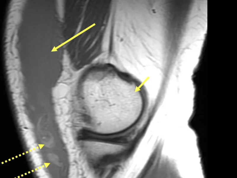 B. Sagittal T1 of the left knee shows a large intermediate to low T2 signal collection (long solid arrow), with dependently positioned fat globules (dotted arrows) in the deep subcutaneous tissue anterior to the distal femur (short arrow).