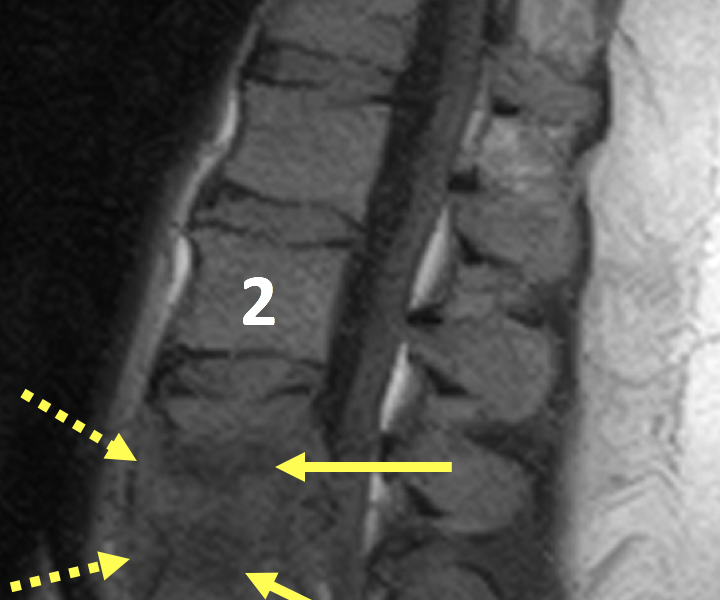 Vertebral discitis-osteomyelitis (VDO) in a 44-year-old man with back pain. A. Sagittal T1 SE MR image shows abnormal hypointense signal within the L3 and L4 vertebral bodies (arrows) and intervening disc, as well as complete destruction of the inferior end plate of L3 and the superior end plate of L4. There is low signal prevertebral soft tissue fullness (dashed arrows). The L2 (2) and L5 (5) vertebral bodies are normal in appearance.
