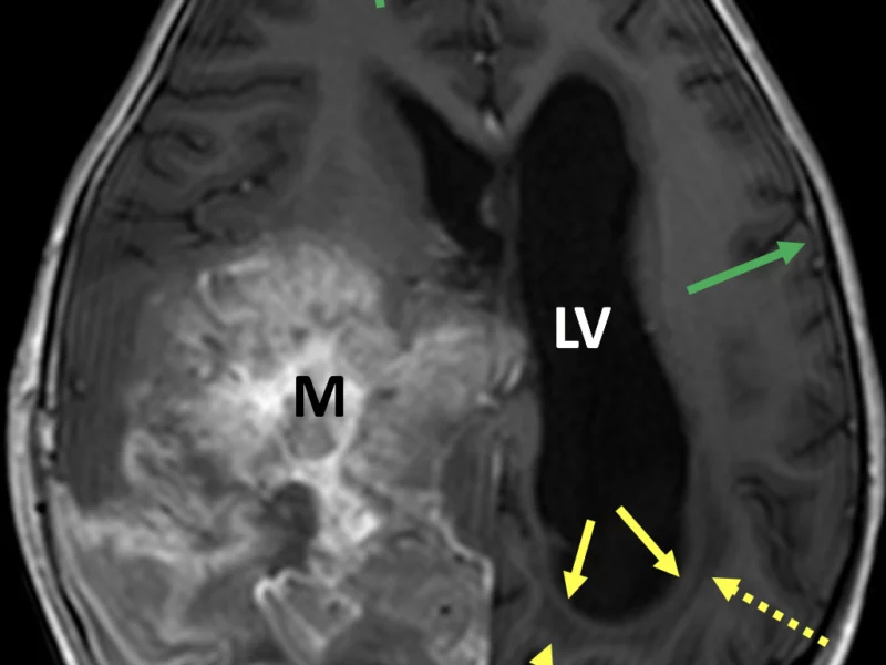Hydrocephalus in a 4-year-old girl post biopsy of a large right hemispheric embryonic tumor. A. Axial 3D FFE MR image post contrast shows enlargement of the left lateral ventricle (LV) and midline shift, secondary to a large heterogeneous enhancing mass (M). Note low signal periventricular fluid representing transependymal flow of CSF (dashed arrows), rounding of the horn of the left lateral ventricle (solid yellow arrows), and squaring of the gyri abutting the calvarium (green arrows). The sulci are not enlarged.