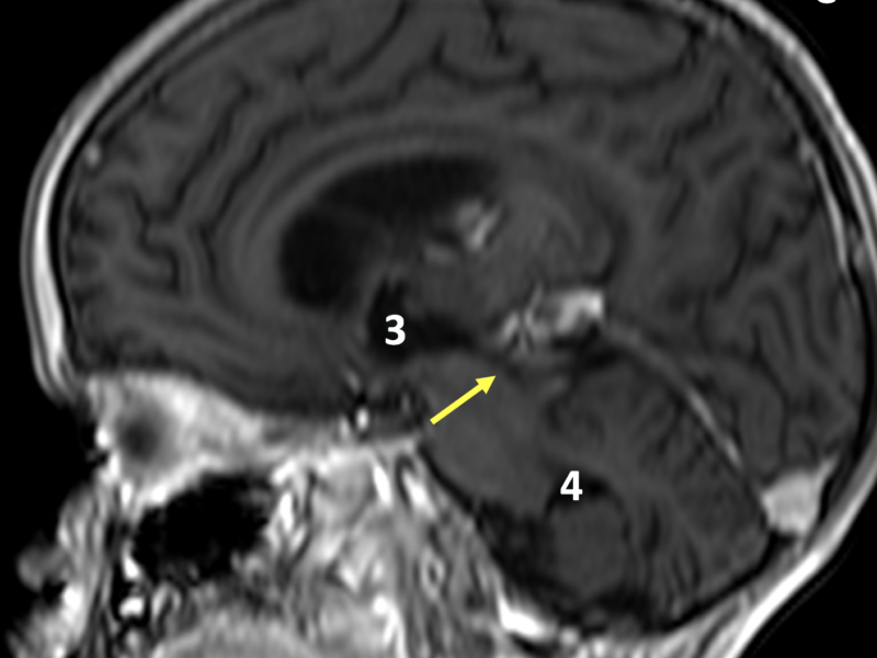 C. Sagittal 3D FFE image post contrast, inferior to (B), shows a patent aqueduct of Sylvius (arrow) carrying CSF to the 4th ventricle (4). The 3rd ventricle (3) is enlarged and deviated anteriorly. Blurring is due to motion artifact.