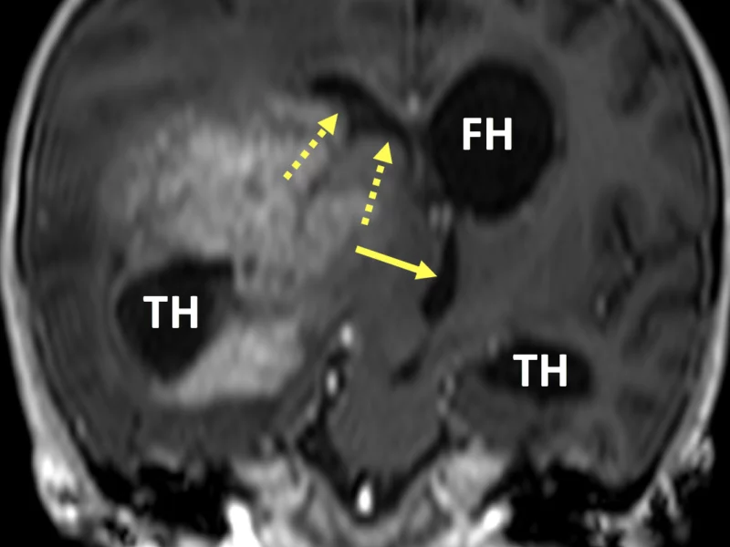 D. Coronal 3D FFE image post contrast shows compression on and leftward deviation of the third ventricle (solid arrow) by a large enhancing mass. There is effacement of the frontal horn of the right lateral ventricle (dashed arrows) and enlargement of the left frontal horn (FH) and both temporal horns (TH). The right temporal horn is “entrapped”, meaning it secretes CSF but does not freely communicate with the rest of the lateral ventricle. Blurring is due to motion artifact.