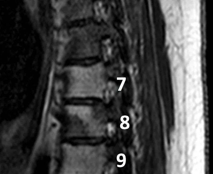 B. Sagittal T2 image shows abnormal high signal within vertebral bodies T7-10.