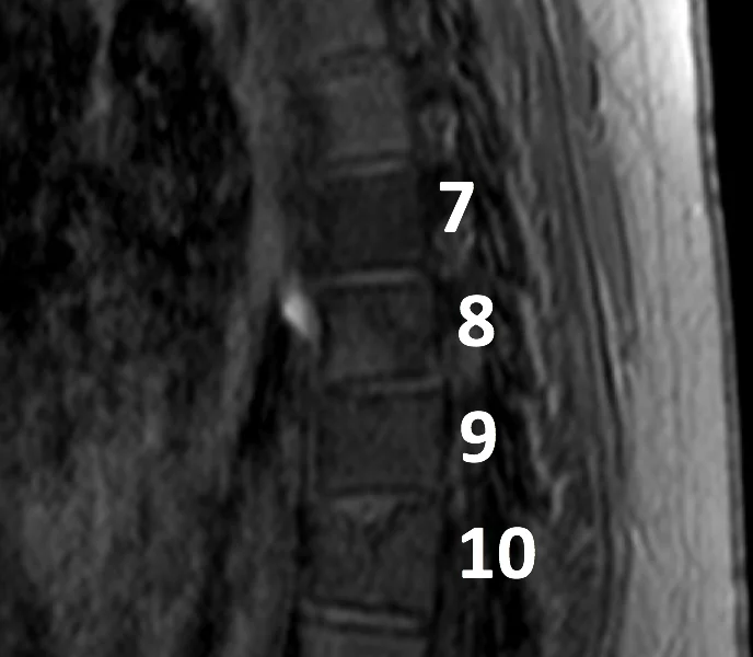Hodgkin disease in an 18-year-old woman post chemotherapy. A. Sagittal T1 turbo spin echo (TSE) MR image shows abnormal low signal within vertebral bodies T7-10. There is no vertebral body collapse.